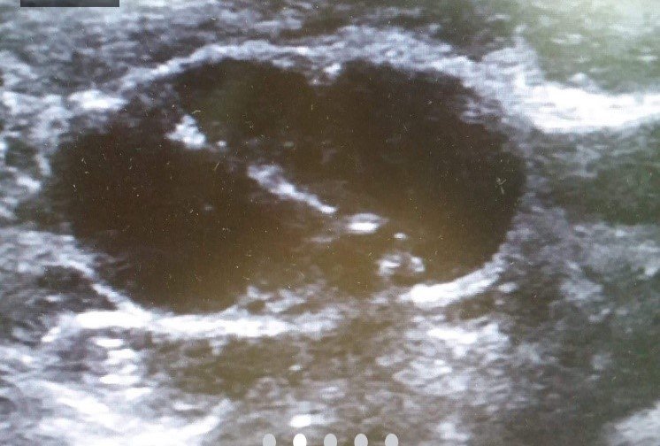 Non-Vascular Interventions