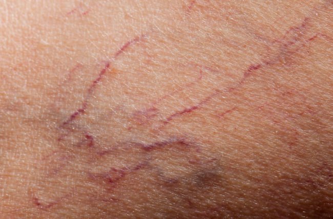 Vascular (Artery & Vein) Interventions